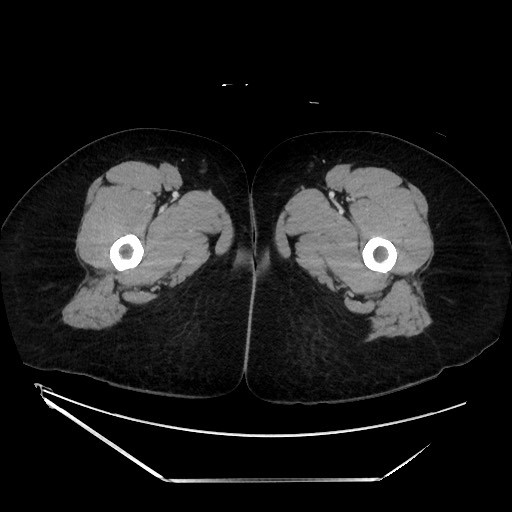 File:Acute uncomplicated appendicitis (Radiopaedia 73704-84499 Axial C+ portal venous phase 191).jpg