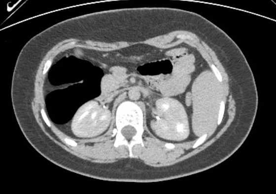 Acute unilateral nonhemorrhagic adrenal infarction (Radiopaedia 67560-76957 Axial renal excretory phase 63).jpg