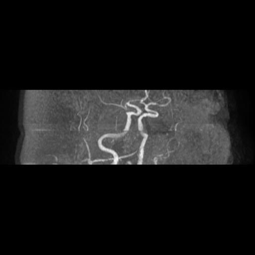 File:Acute vertebrobasilar ischemic infarction (Radiopaedia 25220-25474 Axial MRA 17).jpg
