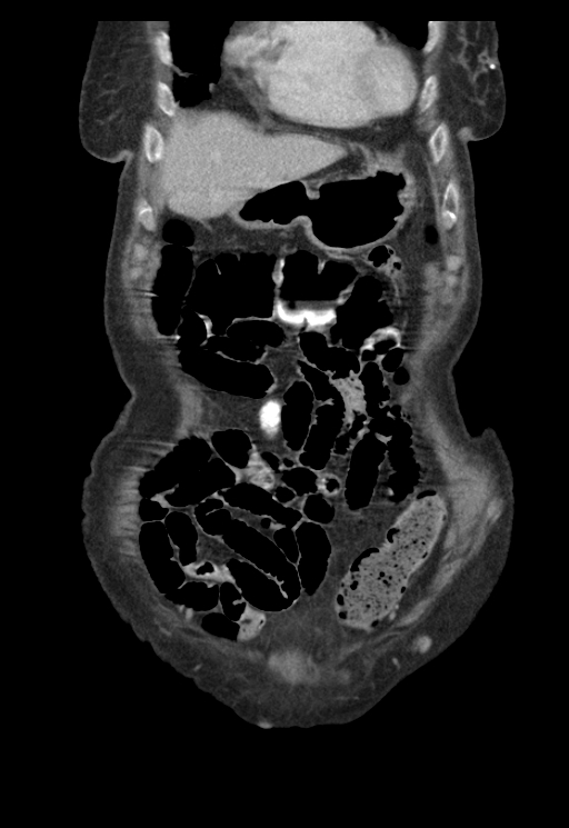 Adenocarcinoma of cecum (Radiopaedia 59222-66549 Coronal C+ portal venous phase 9).jpg
