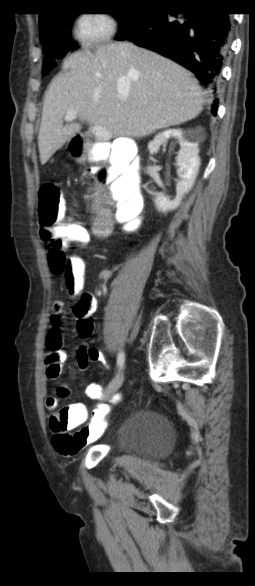 Adenocarcinoma of cecum (Radiopaedia 59222-66549 Sagittal C+ portal venous phase 65).jpg