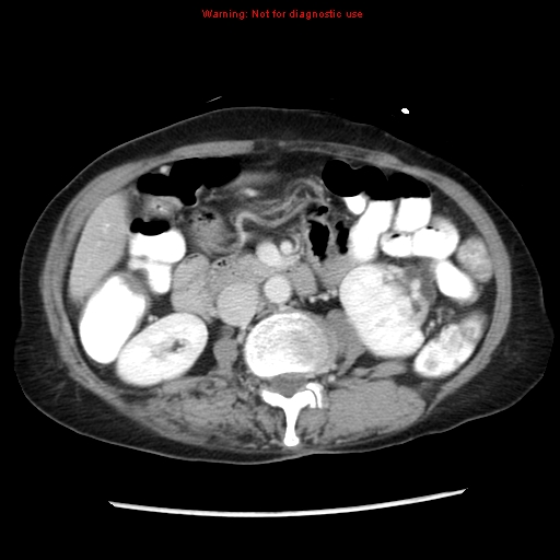 Adenocarcinoma of the colon (Radiopaedia 8191-9039 Axial liver window 34).jpg