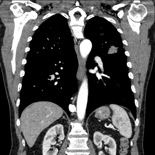 Adenocarcinoma of the lung (Radiopaedia 59871-67325 Coronal C+ arterial phase 45).jpg