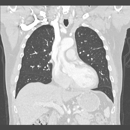 Adenocarcinoma of the lung (Radiopaedia 59871-67325 Coronal lung window 22).jpg