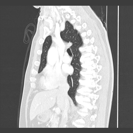 Adenocarcinoma of the lung (Radiopaedia 59871-67325 Sagittal lung window 44).jpg