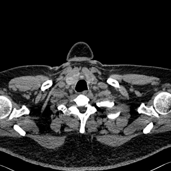 Adenoid cystic carcinoma of the trachea (Radiopaedia 49042-54137 Axial non-contrast 8).jpg