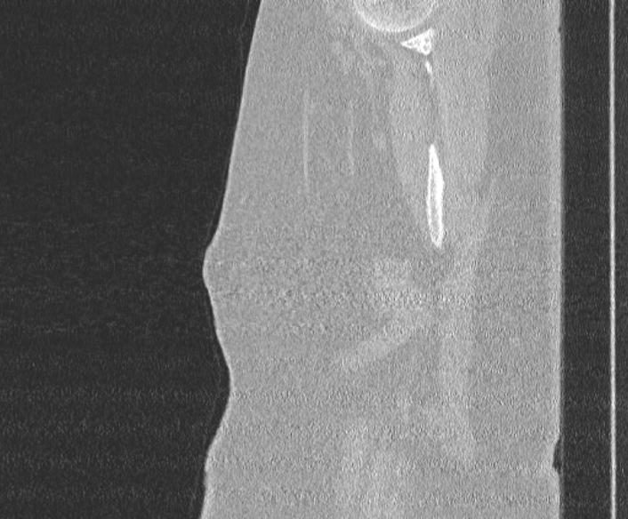 Adenoid cystic carcinoma of the trachea (Radiopaedia 49042-54137 Sagittal lung window 1).jpg
