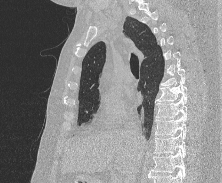 File:Adenoid cystic carcinoma of the trachea (Radiopaedia 49042-54137 Sagittal lung window 211).jpg