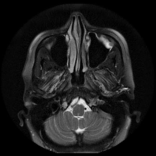File:Adenoid cystic tumor of palate (Radiopaedia 46980-51519 Axial T2 26).png