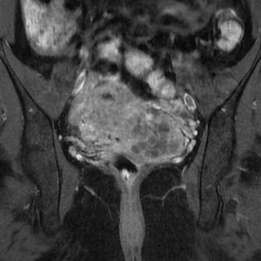 File:Adenoma malignum of cervix (Radiopaedia 66441-75705 Coronal T1 C+ fat sat 9).jpg