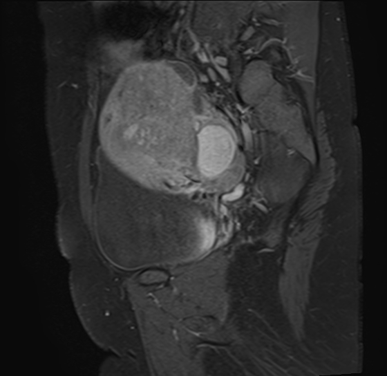 File:Adenomyosis - ovarian endometriomas (Radiopaedia 67031-76350 Sagittal T1 C+ fat sat 18).jpg