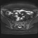 File:Adenomyosis and endometriotic cysts (Radiopaedia 82300-96367 Axial DWI 19).jpg
