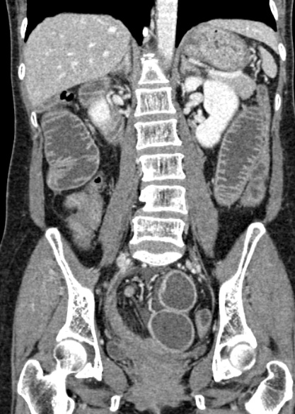File:Adhesional small bowel obstruction (Radiopaedia 48397-53305 Coronal C+ portal venous phase 215).jpg