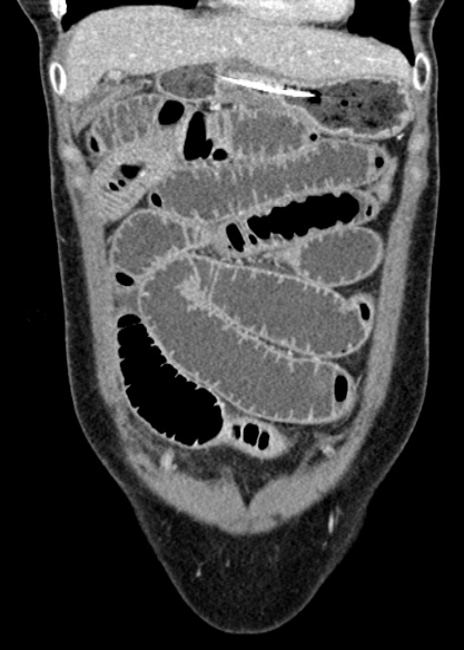 Adhesional small bowel obstruction (Radiopaedia 48397-53305 Coronal C+ portal venous phase 84).jpg