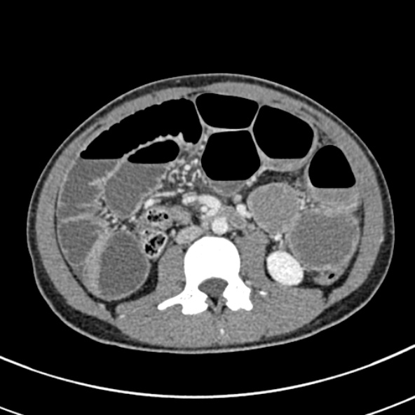 Adhesional small bowel obstruction (Radiopaedia 52107-57980 Axial C+ portal venous phase 59).jpg