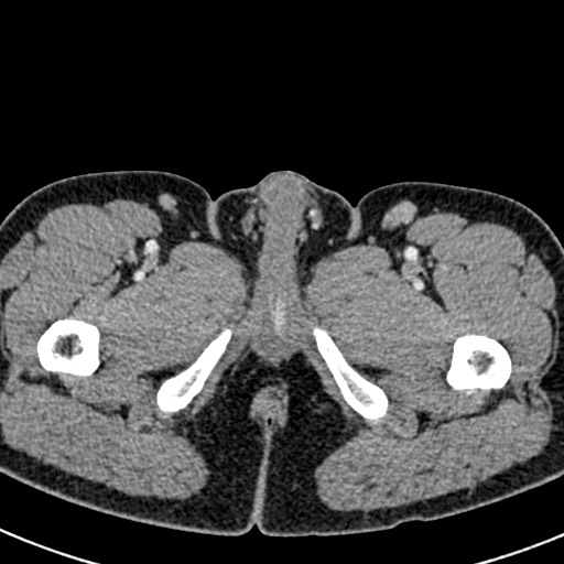 Adhesional small bowel obstruction (Radiopaedia 58900-66131 Axial C+ portal venous phase 59).jpg