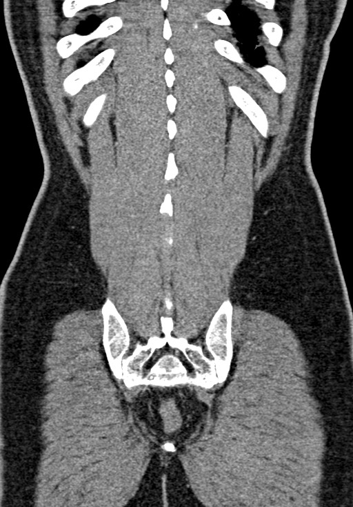 Adhesional small bowel obstruction (Radiopaedia 58900-66131 Coronal C+ portal venous phase 213).jpg