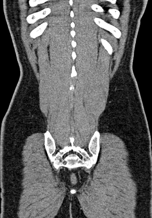 Adhesional small bowel obstruction (Radiopaedia 58900-66131 Coronal C+ portal venous phase 215).jpg