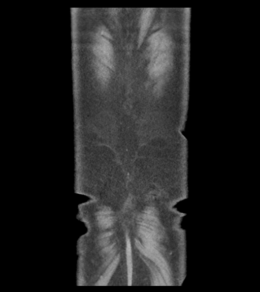 Adhesions within abdominal wall hernia (Radiopaedia 58283-65394 Coronal C+ portal venous phase 66).png