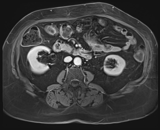 Adrenal cortical carcinoma (Radiopaedia 64017-72770 K 51).jpg