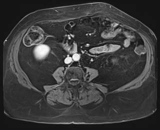Adrenal cortical carcinoma (Radiopaedia 64017-72770 K 62).jpg