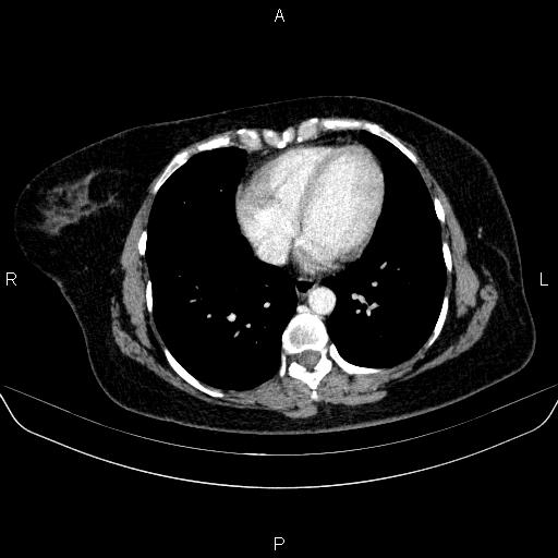 File:Adrenal cortical carcinoma (Radiopaedia 84882-100379 Axial C+ portal venous phase 2).jpg
