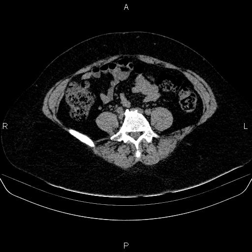 File:Adrenal cortical carcinoma (Radiopaedia 84882-100379 Axial non-contrast 61).jpg