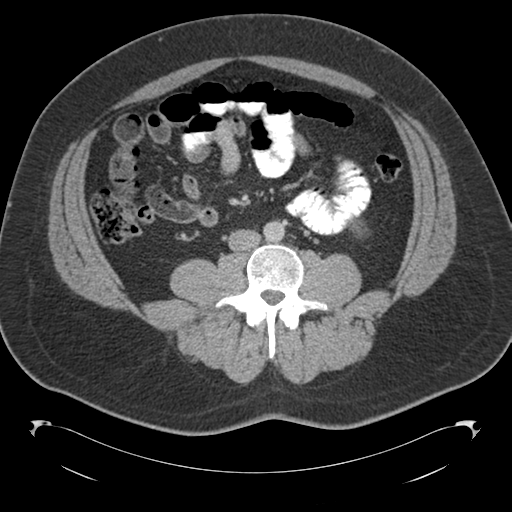 File:Adrenal cyst (Radiopaedia 45625-49776 Axial C+ portal venous phase 56).png