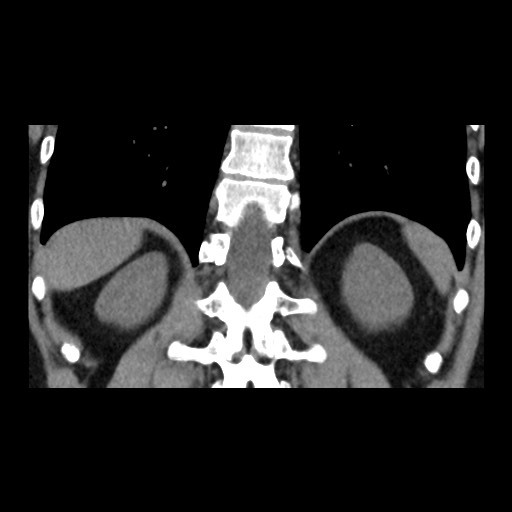 Adrenal gland trauma (Radiopaedia 81351-95079 Coronal non-contrast 69).jpg