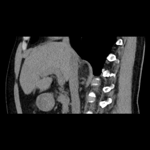 Adrenal gland trauma (Radiopaedia 81351-95079 Sagittal non-contrast 42).jpg