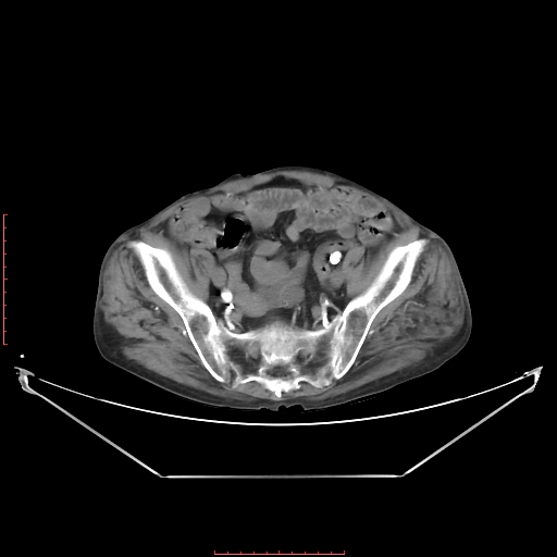 Adrenal hemangioma (Radiopaedia 68923-78668 Axial C+ arterial phase 59).jpg