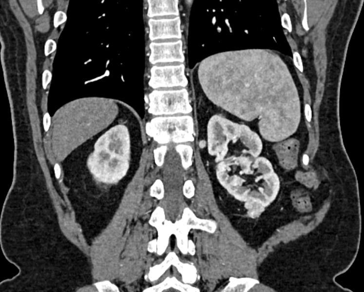 File:Adrenal metastases (Radiopaedia 73082-83791 Coronal C+ arterial phase 61).jpg