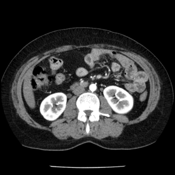 Adrenal myelolipoma (Radiopaedia 43401-46759 Axial C+ arterial phase 51).jpg
