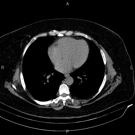 Adrenal myelolipoma (Radiopaedia 84319-99617 Axial With oral contrast 7).jpg