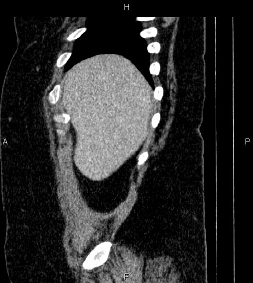 Adrenal myelolipoma (Radiopaedia 84319-99617 Sagittal renal cortical phase 8).jpg