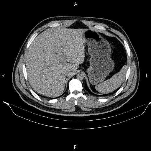 File:Adrenal myelolipoma (Radiopaedia 84321-99619 Axial non-contrast 23).jpg