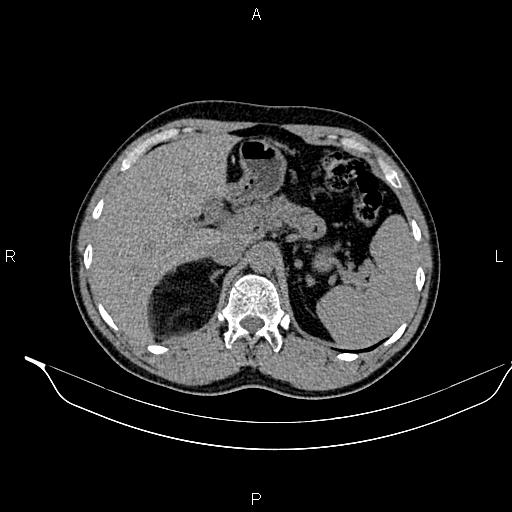 File:Adrenal myelolipoma (Radiopaedia 87794-104246 Axial non-contrast 29).jpg