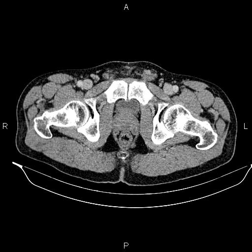 Adrenal myelolipoma (Radiopaedia 87794-104246 Axial renal cortical phase 108).jpg