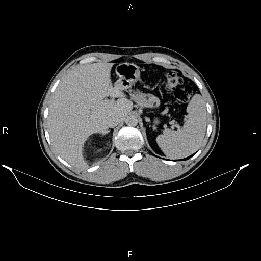 Adrenal myelolipoma (Radiopaedia 87794-104246 Axial renal excretory phase 23).jpg