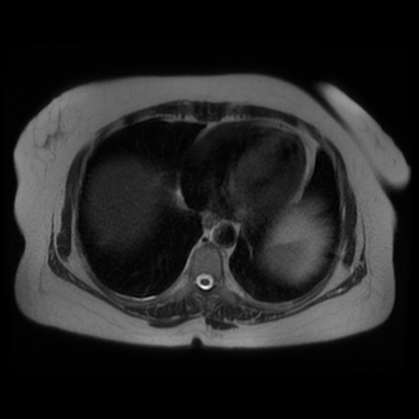 File:Adrenal myelolipoma - MRI (Radiopaedia 83249-97646 Axial T2 3).jpg