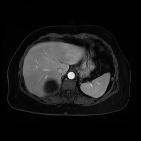Adrenal myelolipoma - MRI (Radiopaedia 83249-97646 T1 fat sat arterial phase 14).jpg
