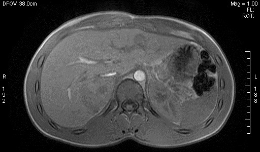 File:Adrenal pheochromocytoma (Radiopaedia 35133-36730 Axial T1 out-of-phase 3).jpg