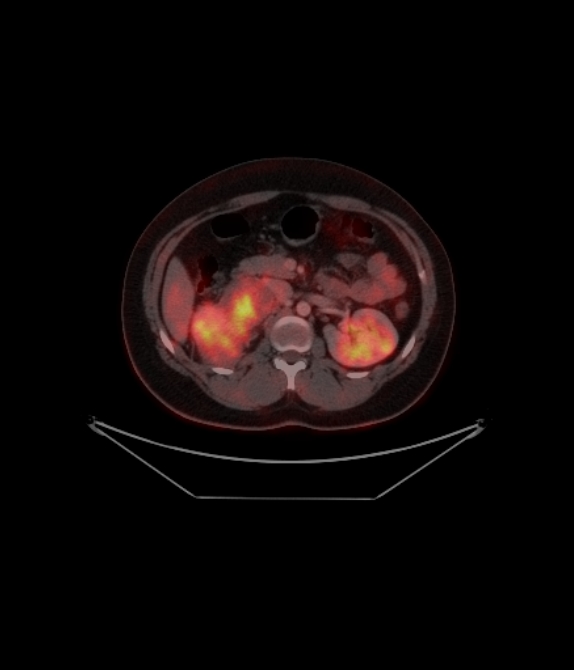 Adrenocortical carcinoma (Radiopaedia 80134-93440 ِAxial 175).jpg