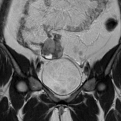 File:Adult granulosa cell tumor of the ovary (Radiopaedia 64991-73953 Coronal T2 7).jpg
