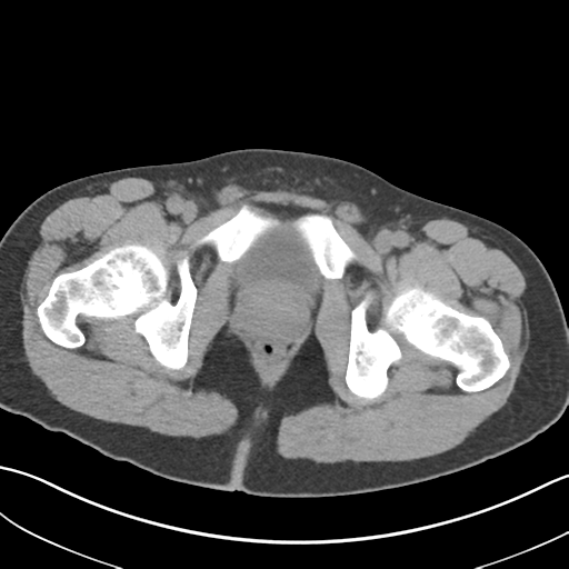 File:Adult polycystic kidney disease (Radiopaedia 47866-52626 Axial non-contrast 85).png