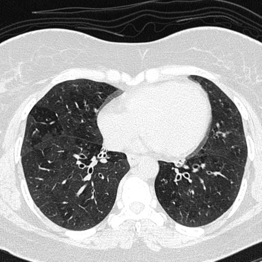 Air trapping in small airway disease (Radiopaedia 61685-69694 Axial lung window 110).jpg