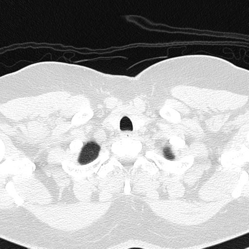File:Air trapping in small airway disease (Radiopaedia 61685-69694 Axial lung window 9).jpg