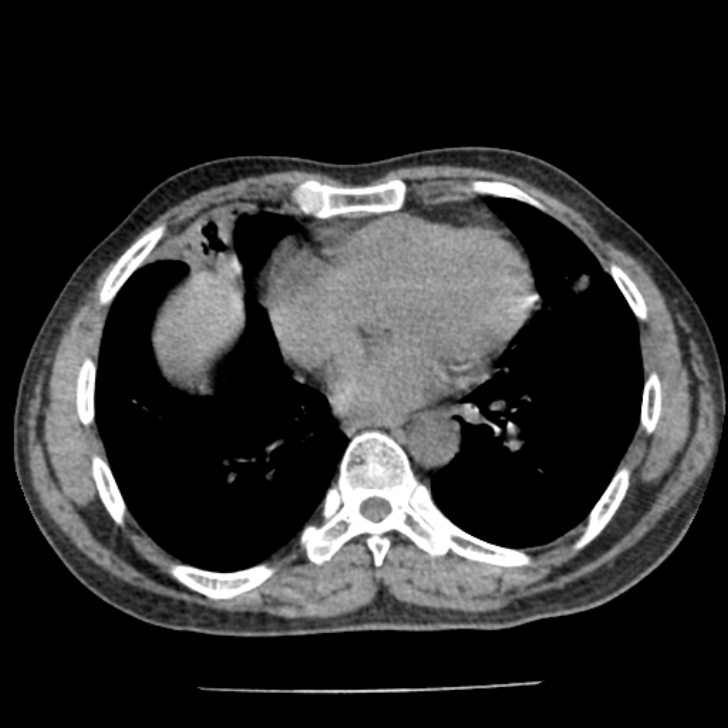 Airway foreign body in adult (Radiopaedia 85907-101779 Axial liver window 122).jpg