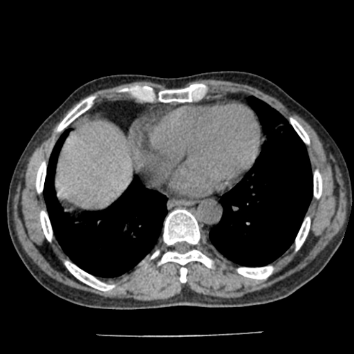 Airway foreign body in adult (Radiopaedia 85907-101779 Axial liver window 129).jpg