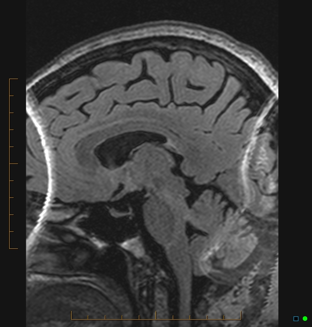 Aliasing artifact causing a spurious cerebellar lesion (Radiopaedia 48783-53810 Sagittal FLAIR 52).jpg